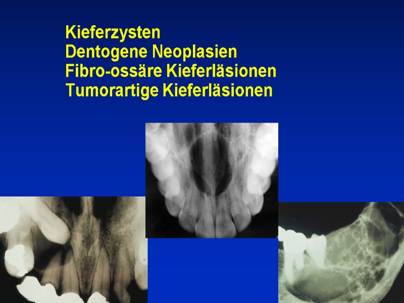 Kieferzysten Dentogene Neoplasien Fibro-ossäre Kieferläsionen Tumorartige Kieferläsionen